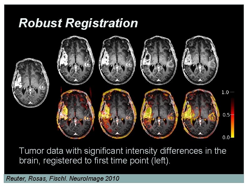 Robust Registration Tumor data with significant intensity differences in the brain, registered to first