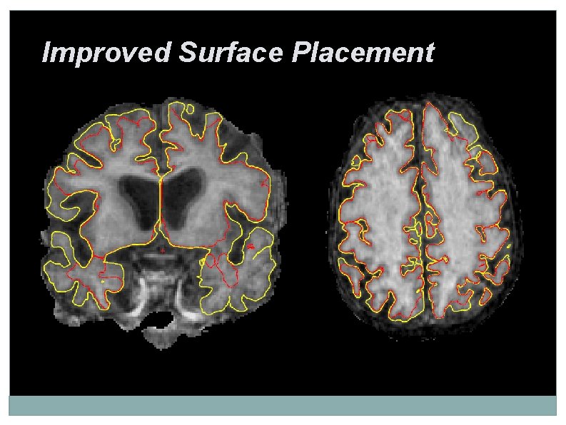Improved Surface Placement 