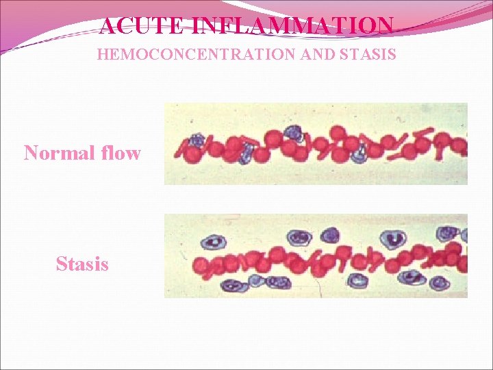 ACUTE INFLAMMATION HEMOCONCENTRATION AND STASIS Normal flow Stasis 