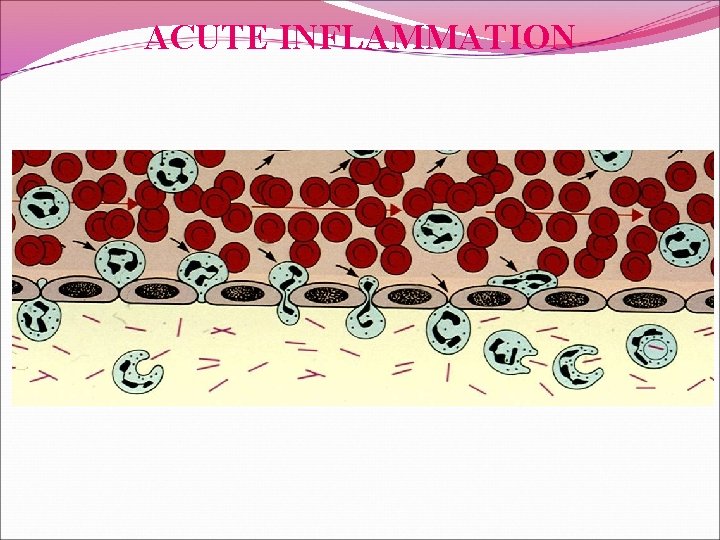 ACUTE INFLAMMATION 