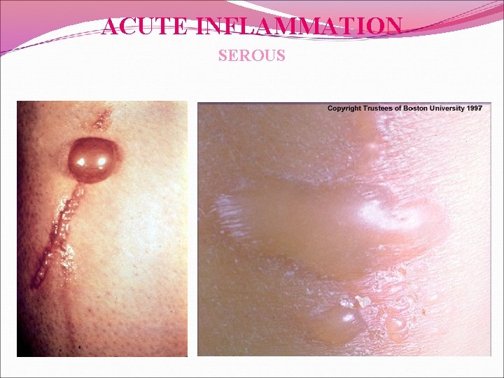 ACUTE INFLAMMATION SEROUS 