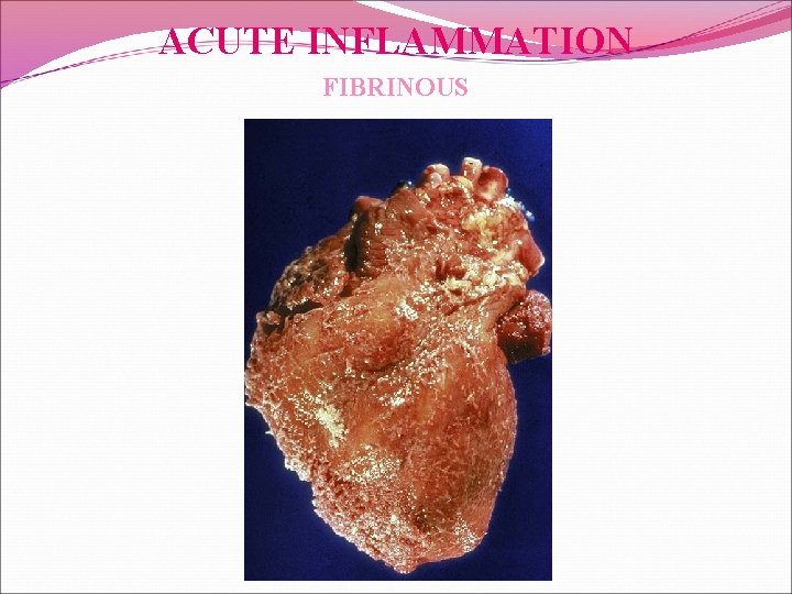 ACUTE INFLAMMATION FIBRINOUS 