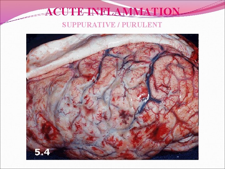 ACUTE INFLAMMATION SUPPURATIVE / PURULENT 