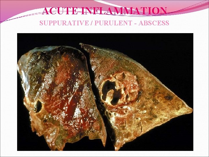 ACUTE INFLAMMATION SUPPURATIVE / PURULENT - ABSCESS 