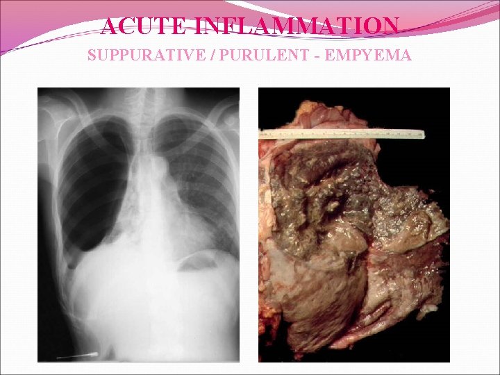 ACUTE INFLAMMATION SUPPURATIVE / PURULENT - EMPYEMA 