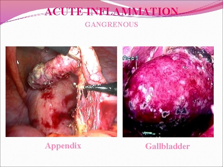 ACUTE INFLAMMATION GANGRENOUS Appendix Gallbladder 