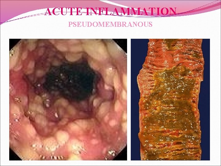 ACUTE INFLAMMATION PSEUDOMEMBRANOUS 