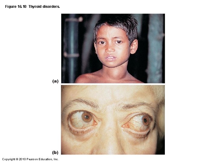 Figure 16. 10 Thyroid disorders. Copyright © 2010 Pearson Education, Inc. 