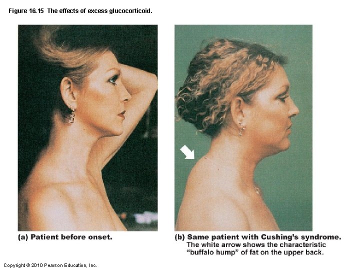 Figure 16. 15 The effects of excess glucocorticoid. Copyright © 2010 Pearson Education, Inc.