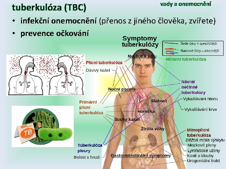 tuberkulóza (TBC) vady a onemocnění • infekční onemocnění (přenos z jiného člověka, zvířete) •