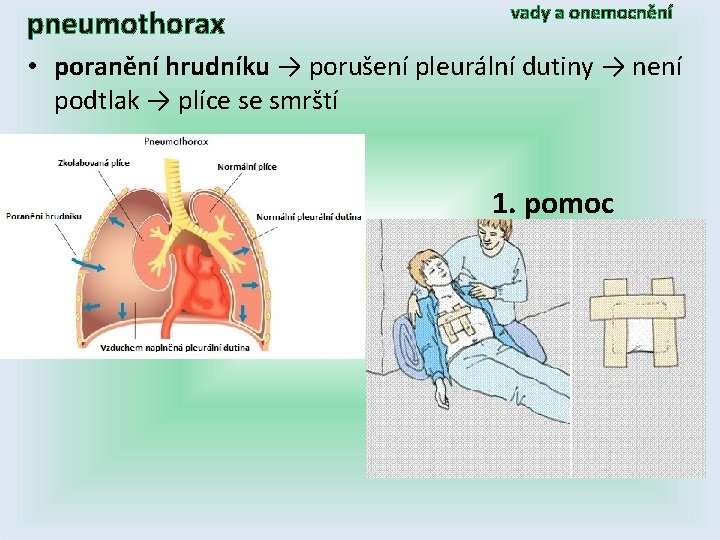 pneumothorax vady a onemocnění • poranění hrudníku → porušení pleurální dutiny → není podtlak