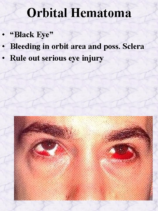 Orbital Hematoma • “Black Eye” • Bleeding in orbit area and poss. Sclera •