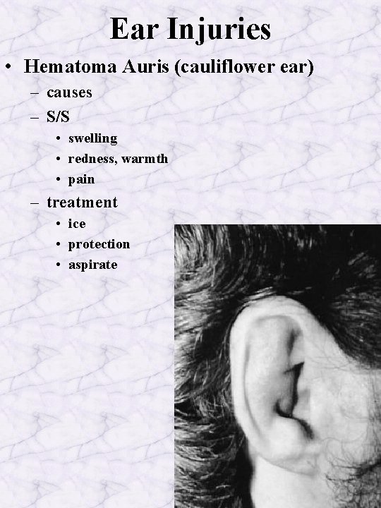 Ear Injuries • Hematoma Auris (cauliflower ear) – causes – S/S • swelling •