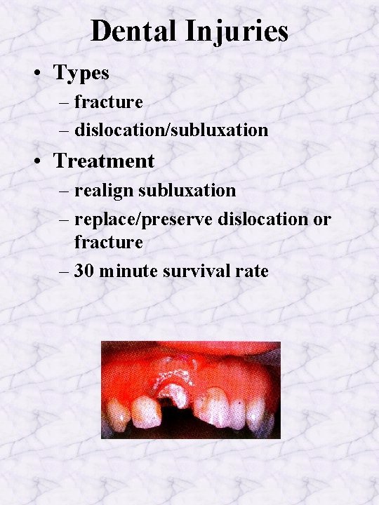 Dental Injuries • Types – fracture – dislocation/subluxation • Treatment – realign subluxation –