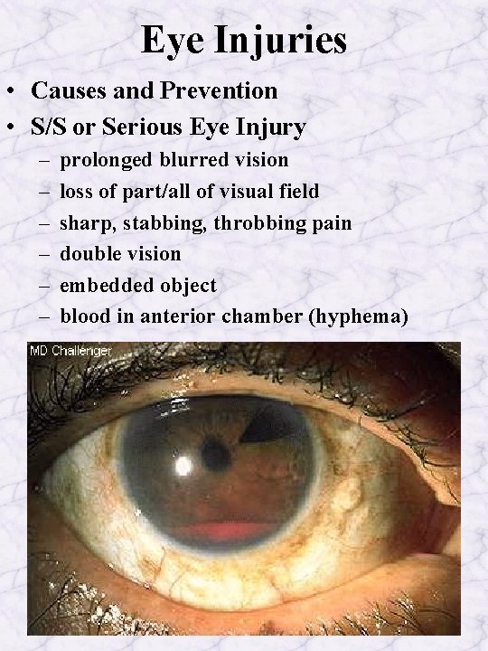 Eye Injuries • Causes and Prevention • S/S or Serious Eye Injury – –