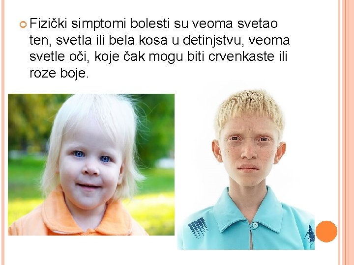  Fizički simptomi bolesti su veoma svetao ten, svetla ili bela kosa u detinjstvu,