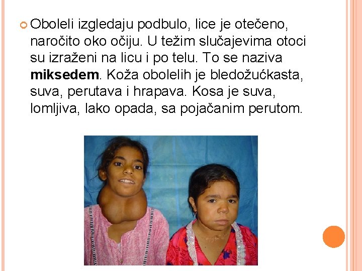  Oboleli izgledaju podbulo, lice je otečeno, naročito oko očiju. U težim slučajevima otoci