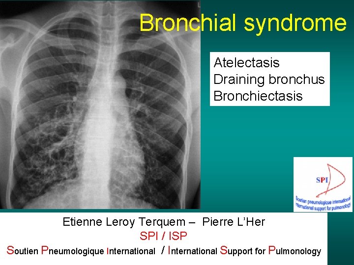 Bronchial syndrome Atelectasis Draining bronchus Bronchiectasis Etienne Leroy Terquem – Pierre L’Her SPI /