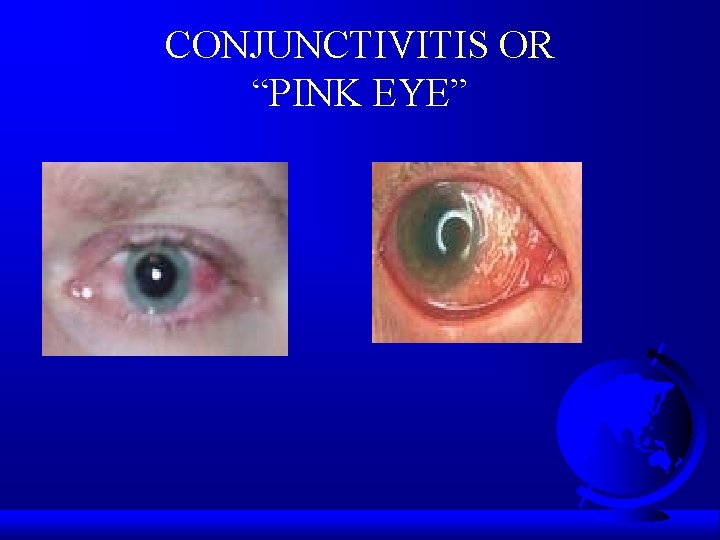 CONJUNCTIVITIS OR “PINK EYE” 