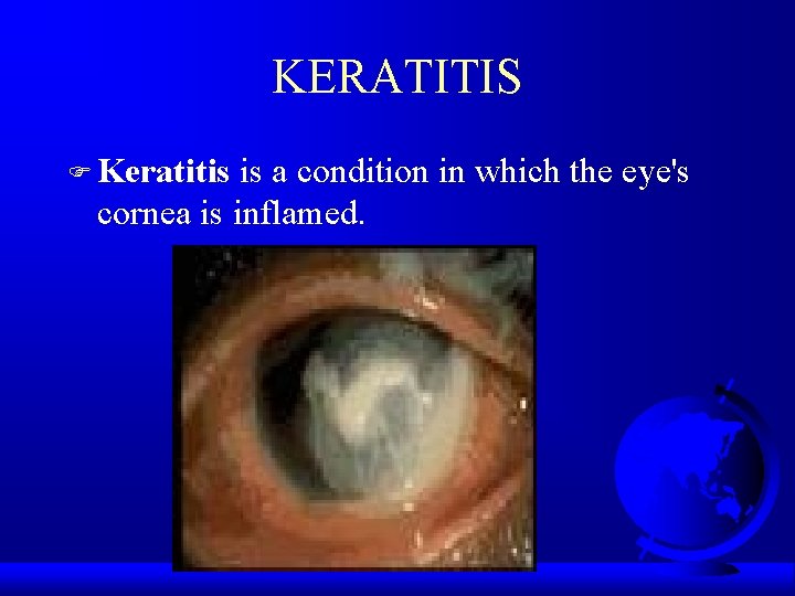 KERATITIS F Keratitis is a condition in which the eye's cornea is inflamed. 