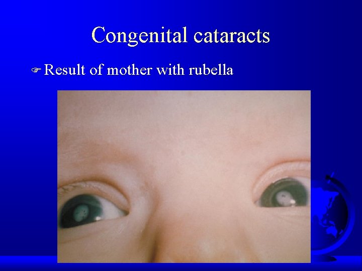 Congenital cataracts F Result of mother with rubella 