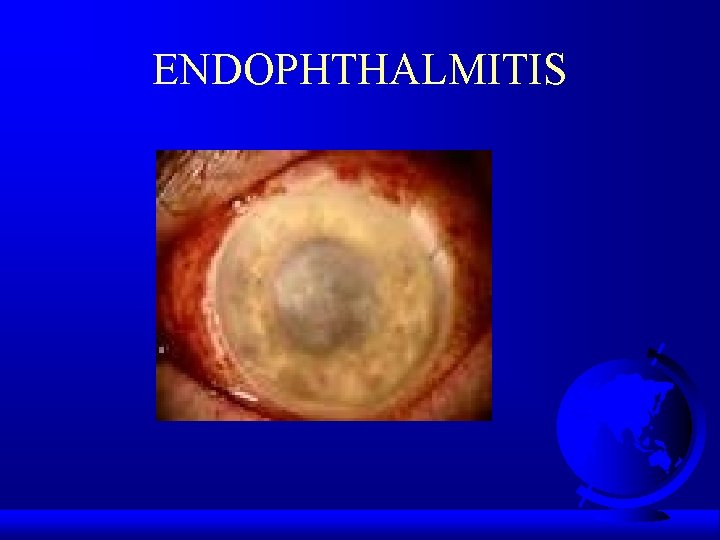 ENDOPHTHALMITIS 