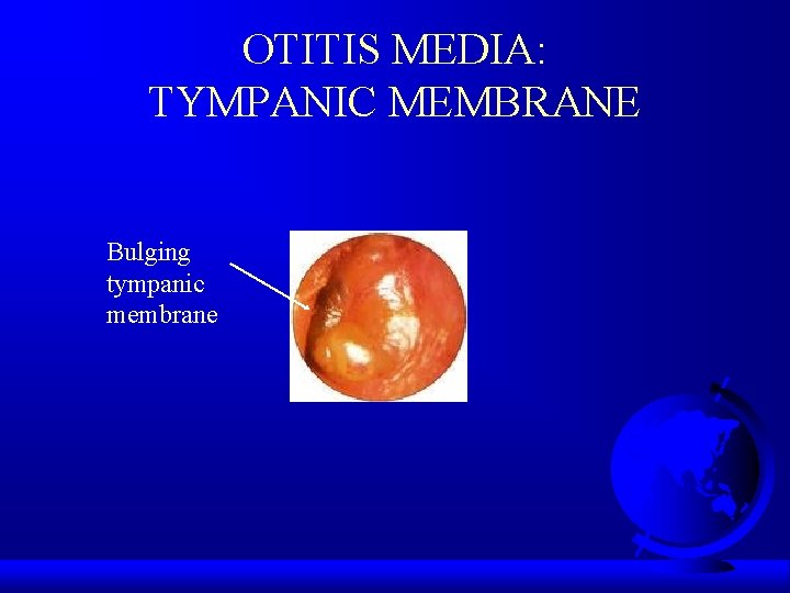 OTITIS MEDIA: TYMPANIC MEMBRANE Bulging tympanic membrane 