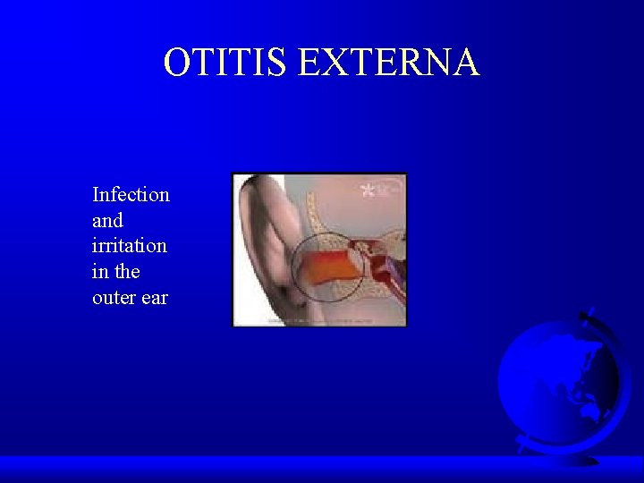 OTITIS EXTERNA Infection and irritation in the outer ear 