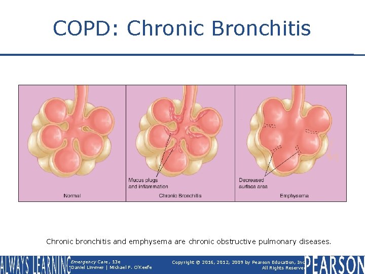 COPD: Chronic Bronchitis Chronic bronchitis and emphysema are chronic obstructive pulmonary diseases. Emergency Care,