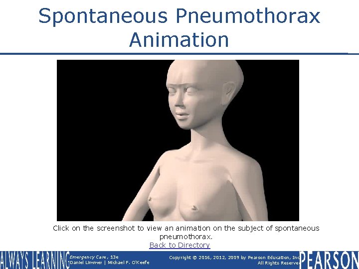 Spontaneous Pneumothorax Animation Click on the screenshot to view an animation on the subject