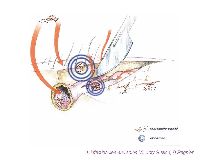 L’infection liée aux soins ML Joly Guillou, B Regnier 