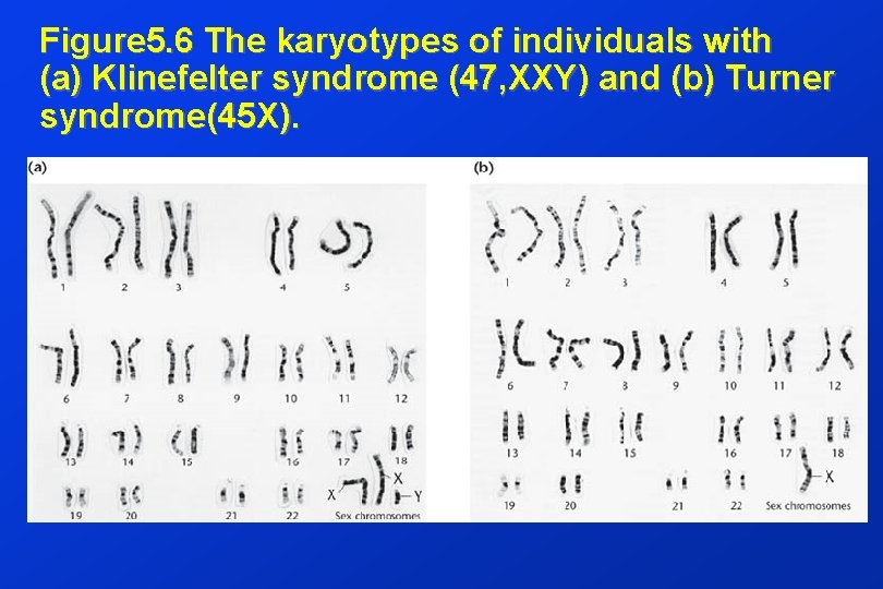 Figure 5. 6 The karyotypes of individuals with (a) Klinefelter syndrome (47, XXY) and