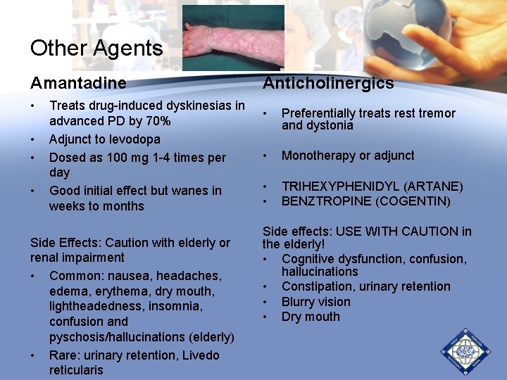 Other Agents Amantadine • • Treats drug-induced dyskinesias in advanced PD by 70% Adjunct Other Agents Amantadine • • Treats drug-induced dyskinesias in advanced PD by 70% Adjunct