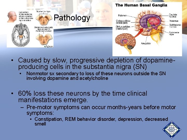 Pathology • Caused by slow, progressive depletion of dopamineproducing cells in the substantia nigra Pathology • Caused by slow, progressive depletion of dopamineproducing cells in the substantia nigra