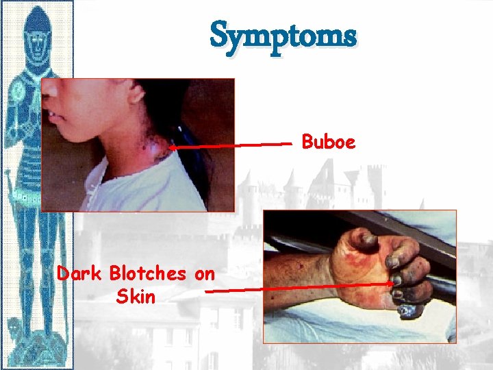 Symptoms Buboe Dark Blotches on Skin 