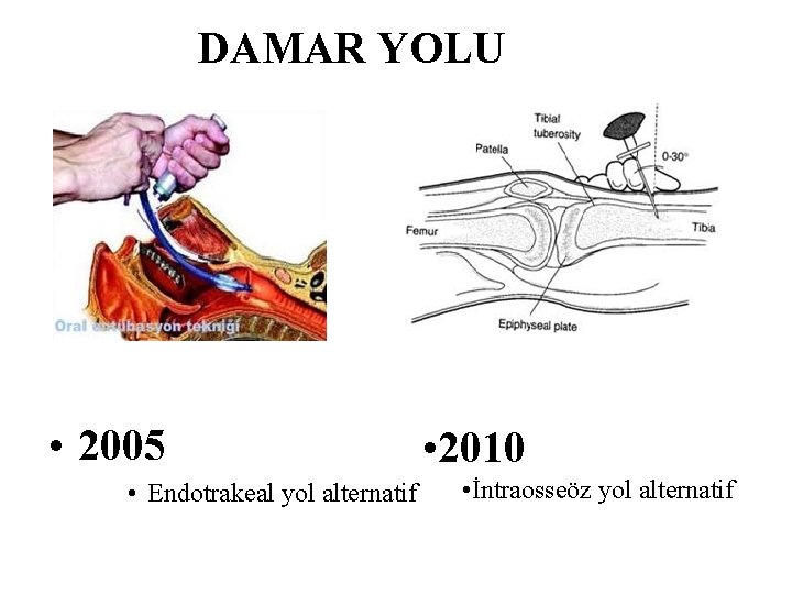 DAMAR YOLU • 2005 • Endotrakeal yol alternatif • 2010 • İntraosseöz yol alternatif