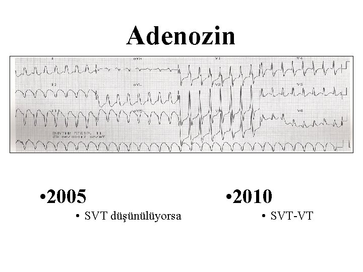 Adenozin • 2005 • SVT düşünülüyorsa • 2010 • SVT-VT 