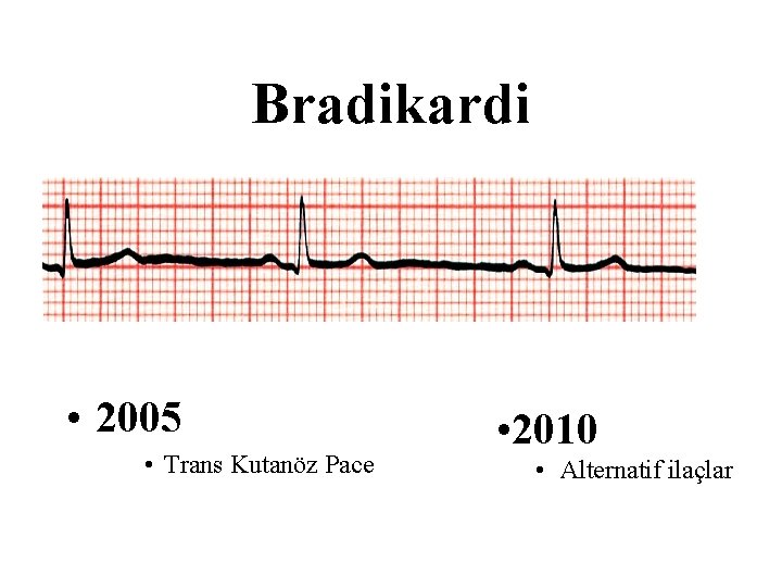 Bradikardi • 2005 • Trans Kutanöz Pace • 2010 • Alternatif ilaçlar 