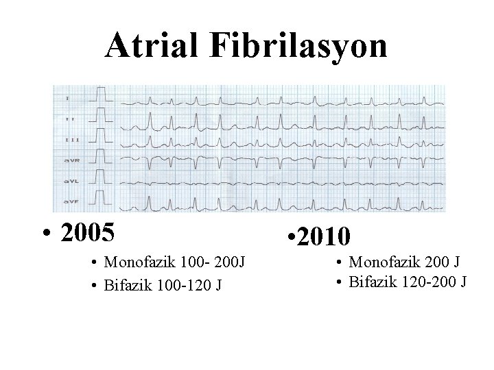 Atrial Fibrilasyon • 2005 • Monofazik 100 - 200 J • Bifazik 100 -120