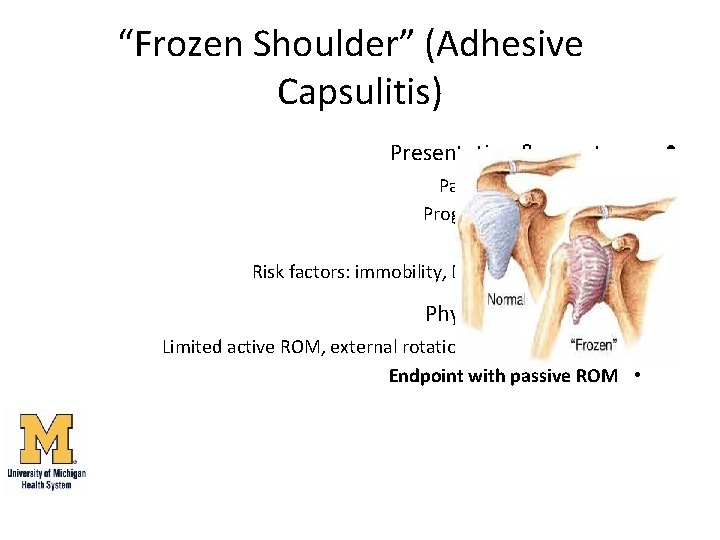 “Frozen Shoulder” (Adhesive Capsulitis) Presentation & symptoms: Pain, often >3 months Progressive loss of