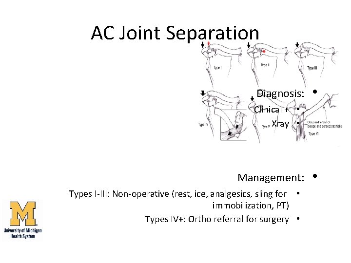 AC Joint Separation Diagnosis: • Clinical + • Xray • Management: Types I-III: Non-operative