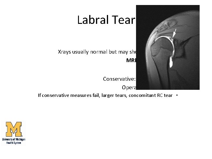 Labral Tear Diagnosis: • Xrays usually normal but may show Hills-Sach lesion • MRI