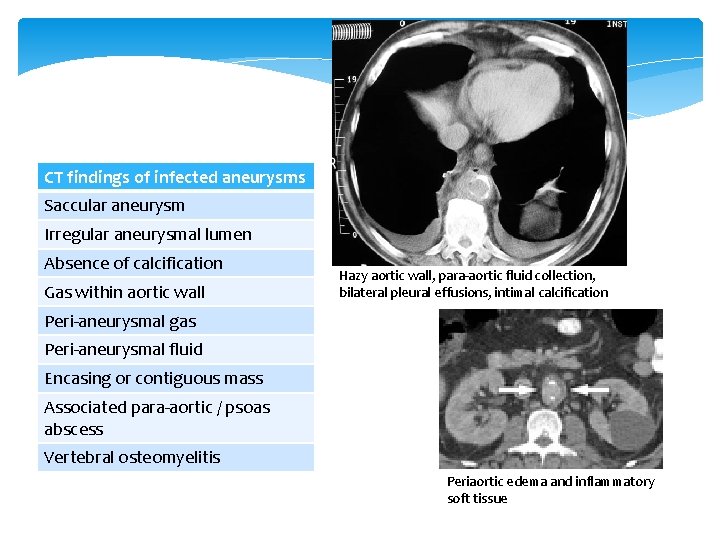CT findings of infected aneurysms Saccular aneurysm Irregular aneurysmal lumen Absence of calcification Gas