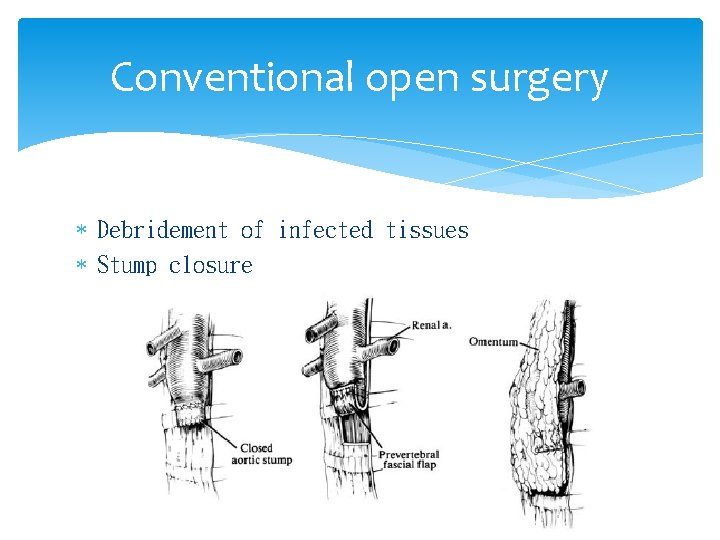 Conventional open surgery Debridement of infected tissues Stump closure 