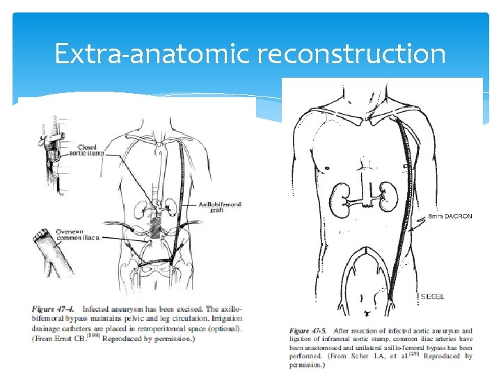 Extra-anatomic reconstruction 