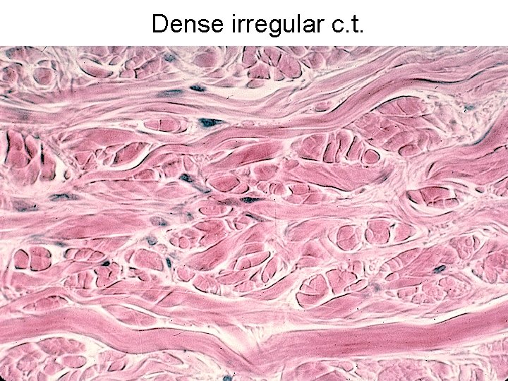 Dense irregular c. t. 