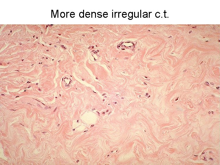 More dense irregular c. t. 