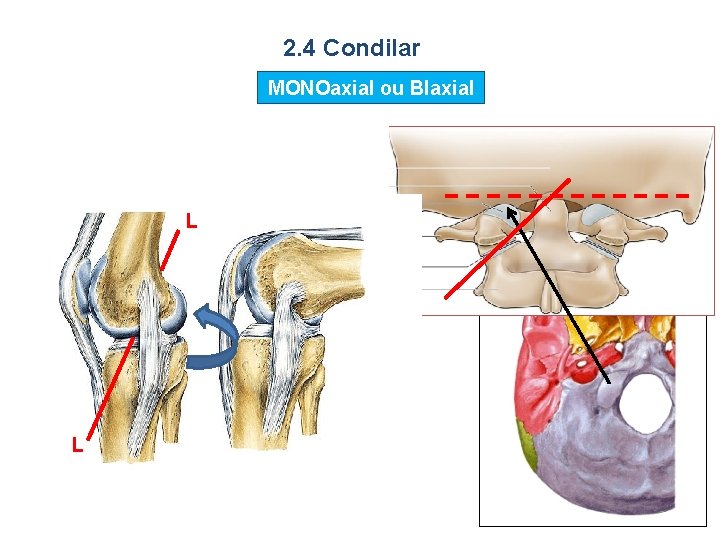 2. 4 Condilar MONOaxial ou BIaxial L L 