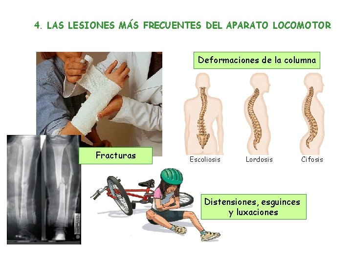 4. LAS LESIONES MÁS FRECUENTES DEL APARATO LOCOMOTOR Deformaciones de la columna Fracturas Escoliosis