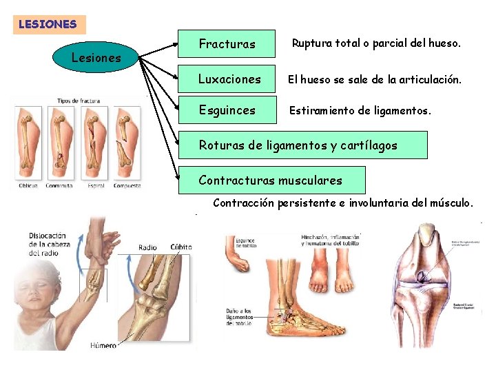 LESIONES Lesiones Fracturas Ruptura total o parcial del hueso. Luxaciones El hueso se sale